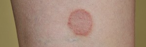 Ringworm in a person